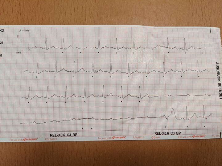 EKG