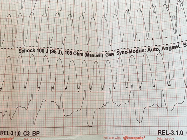 EKG