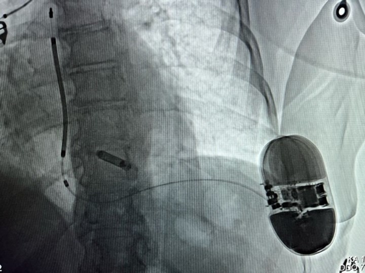 Sondenloser Schrittmacher