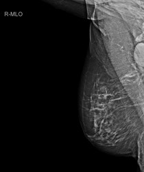 Scout im Brusttumor und Mammografie