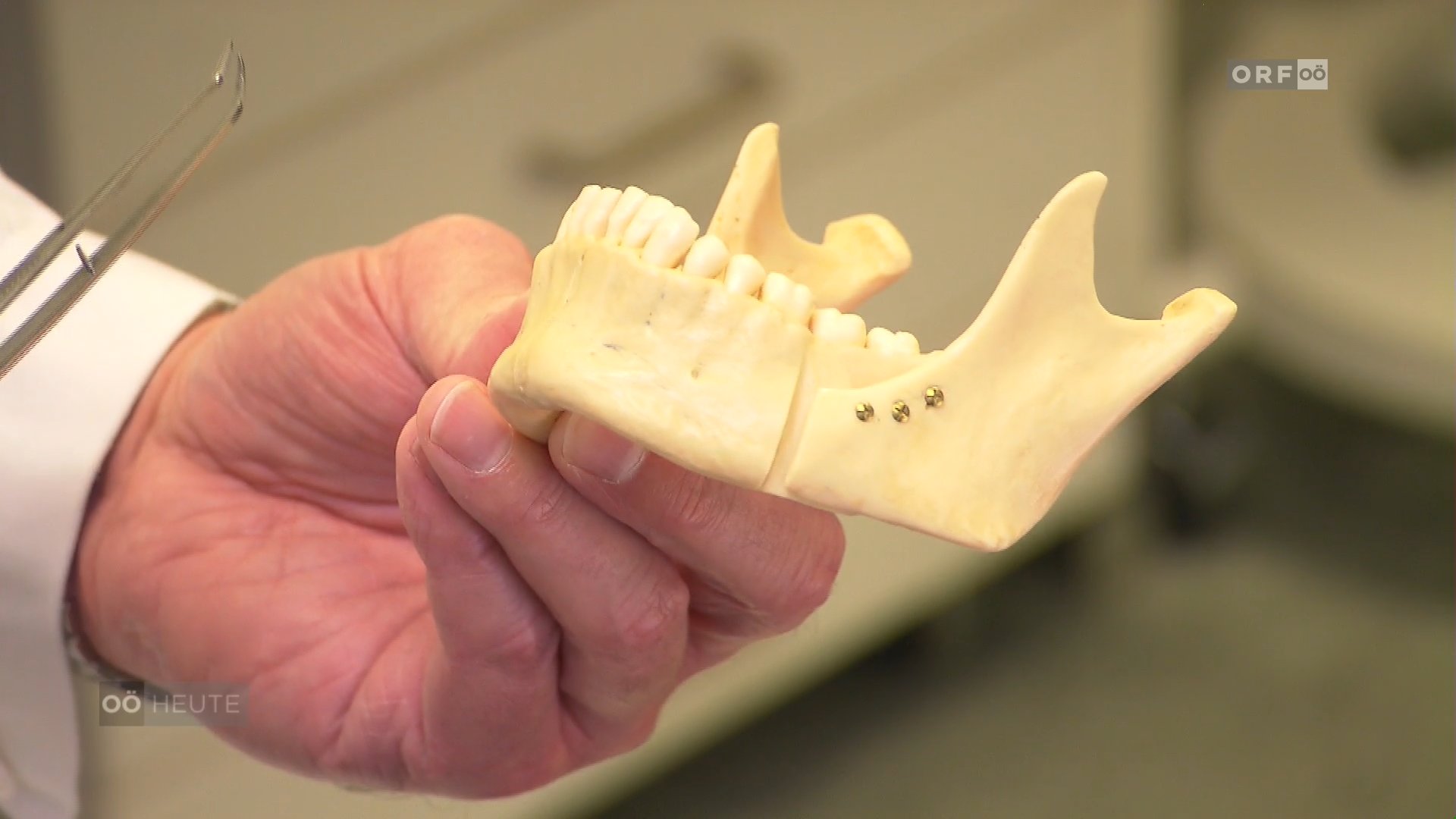 Frühzeitige chirurgische Eingriffe bei Kieferfehlstellungen beugen Spätfolgen vor