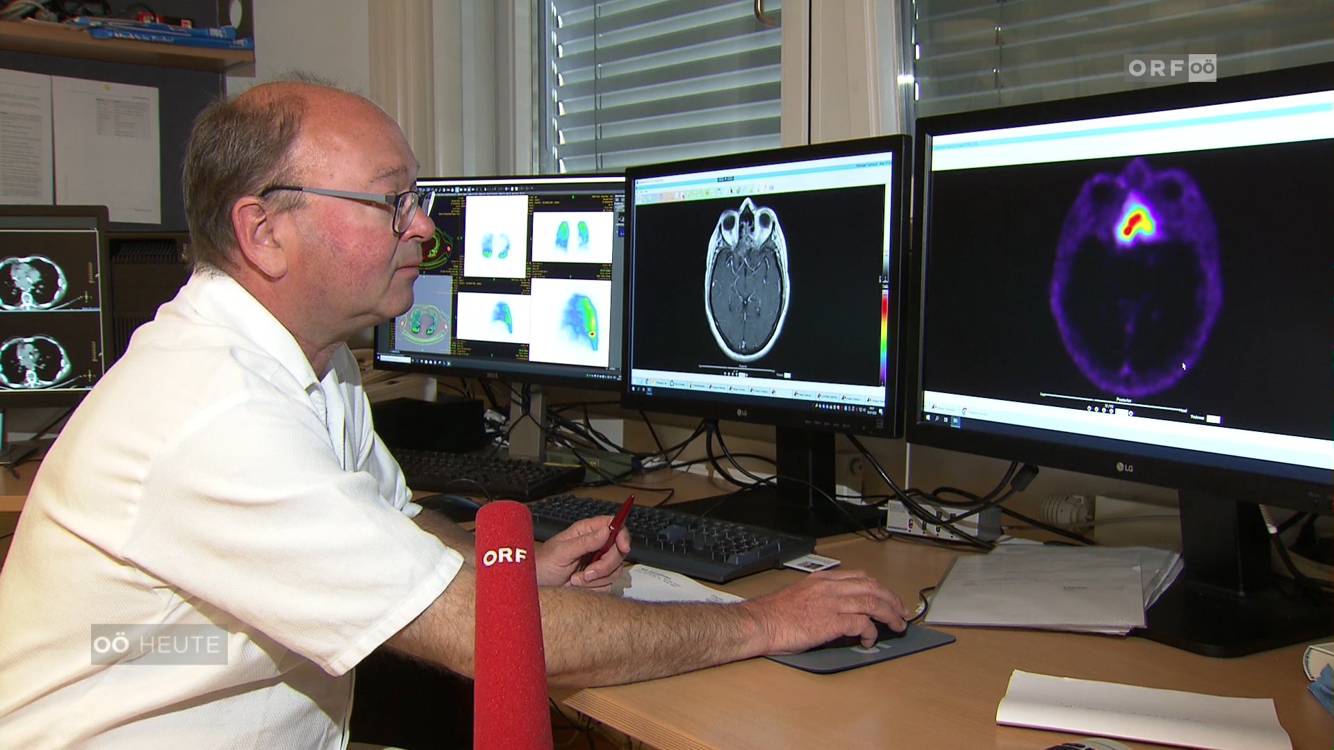 Operative Behandlung von Hirntumoren als Kernkompetenz der Neurochirurgie
