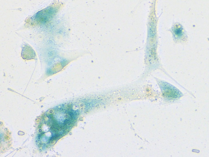 Seneszente Zellen der Nasenschleimhaut